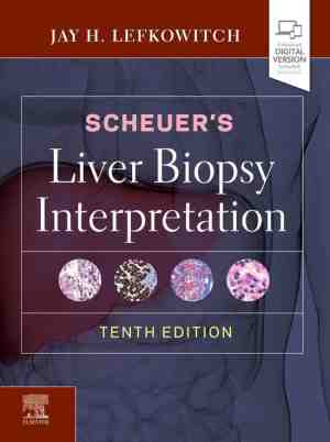 Foto: Scheuers liver biopsy interpretation