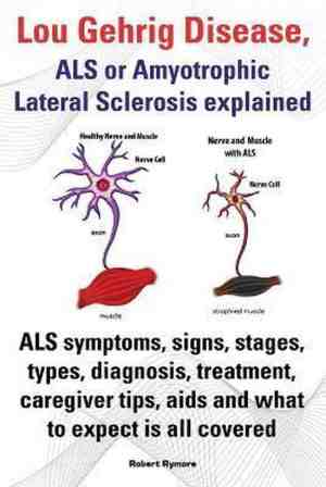 Foto: Lou gehrig disease als or amyotrophic lateral sclerosis explained  als symptoms signs stages types diagnosis treatment caregiver tips aids and what to expect all covered 